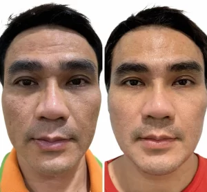 results from salmon pdrn
