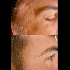 Glass peel on man's face