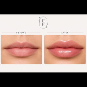 tulip lip treatment in flagstaff