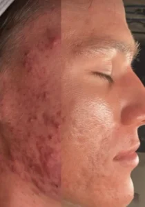 acne treatment with ultra plasma at ethereal esthetics by ashley