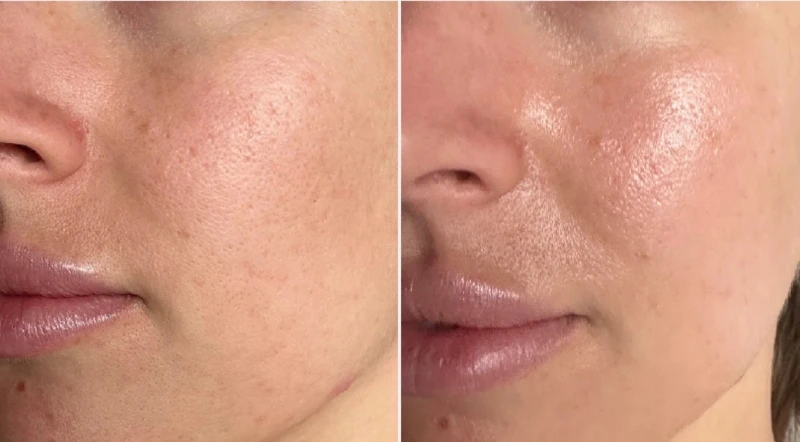 lactic glycolic peel with ashley at ethereal esthetics