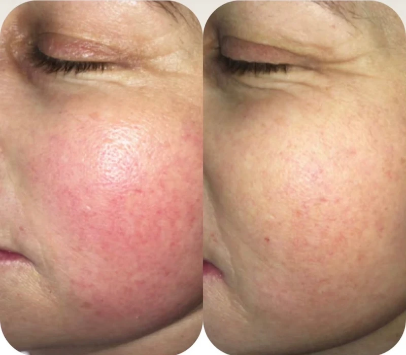rosacea treatment with colostrum peel and microchanneling with stem cell