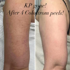 colostrom peels on arms in flagstaff